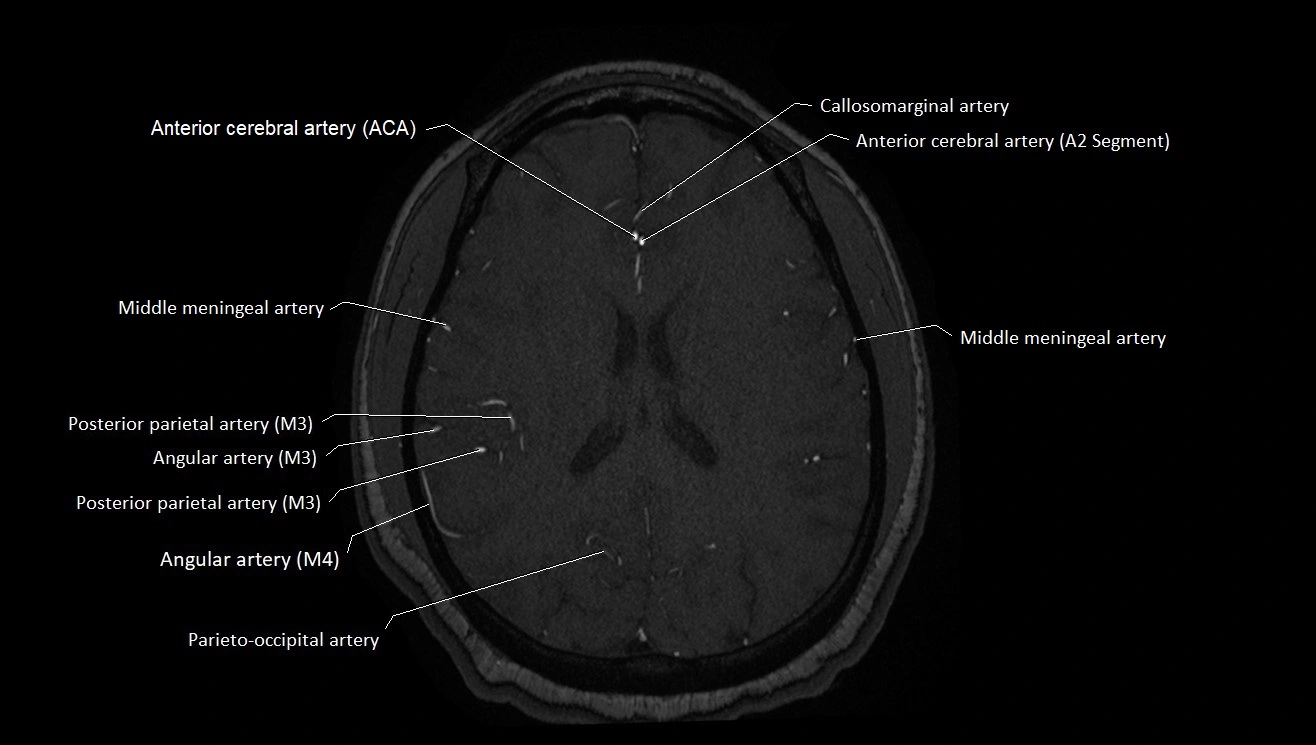 MRA brain (cerebral arteries) anatomy axial 3T image 37.webp